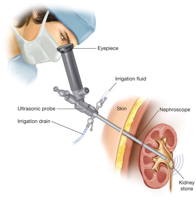 Rirs Pcnl Micro Pcnl Minipcnl Lasers Urology Rirs Surgeon In 