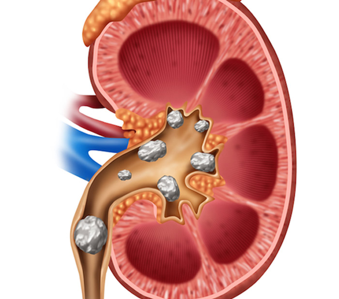 Collection 30+ Photos what does a 9 mm kidney stone look like Updated Collection 30+ Photos what does a 9 mm kidney stone look like Updated