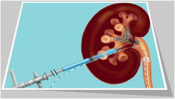 best way to treat kidney stones at home